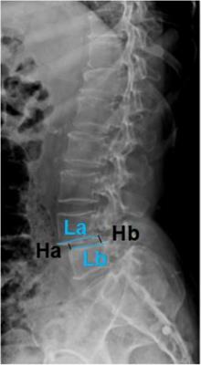 Study and analysis of the correlation between lumbar spondylolisthesis and Modic changes